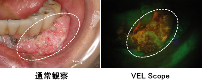 歯肉扁平上皮癌