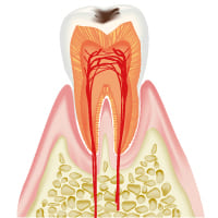 C1 むし歯の第一段階（軽度の虫歯）