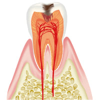 C2　むし歯の第二段階（軽度の虫歯）