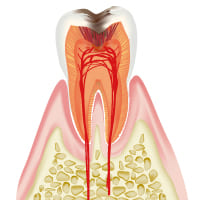 C3　むし歯の第三段階（中度の虫歯）