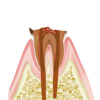 C4　むし歯の第四段階（重度の虫歯）