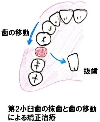 抜歯と矯正治療