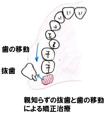 親知らずと矯正治療