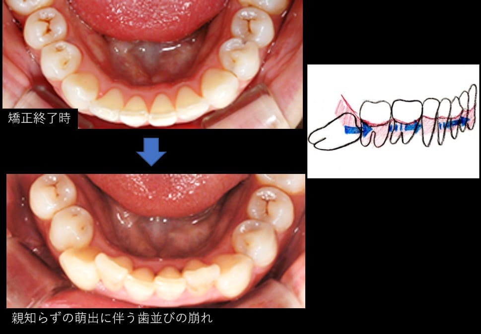 親知らずと歯並び