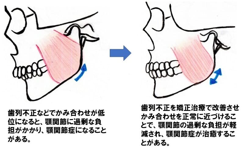 顎関節症を発症している患者さんの矯正治療