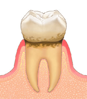 軽度歯周炎