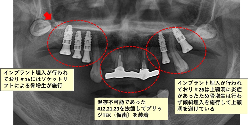 上顎の治療