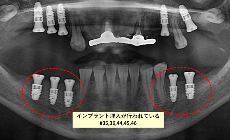 下顎の治療