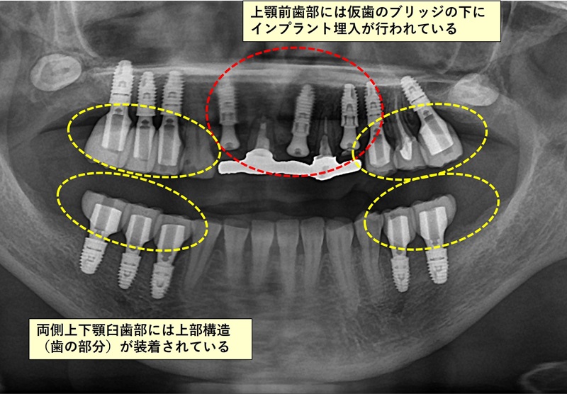 全顎の治療