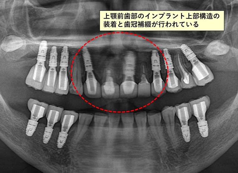 全顎の治療