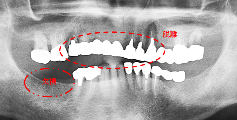 初診時のパノラマXP所見