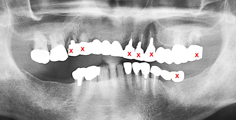 初診時のパノラマX-P所見
