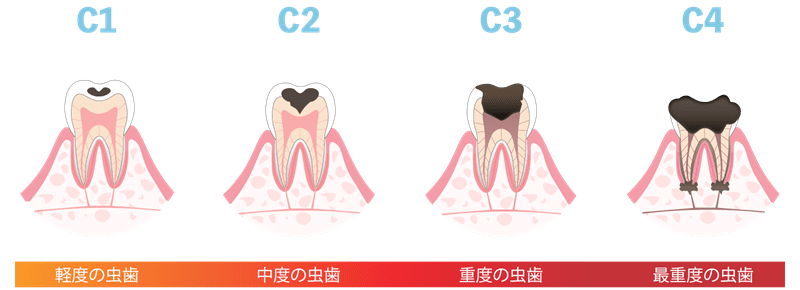 虫歯の進行図