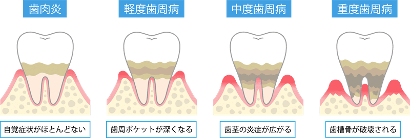 歯周病の進行図