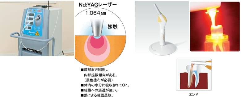 レーザー・光滅菌の応用治療