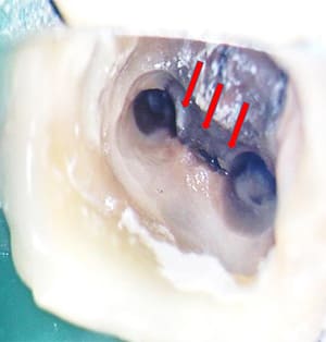 根管治療ケース２マイクロスコープ写真