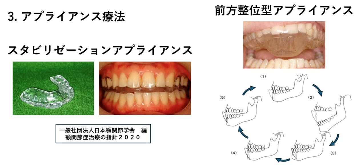 アプライアンス療法