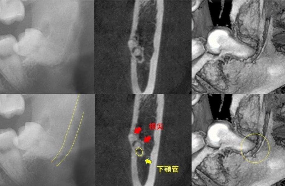 深さが比較的浅いもの（近心傾斜）症例2