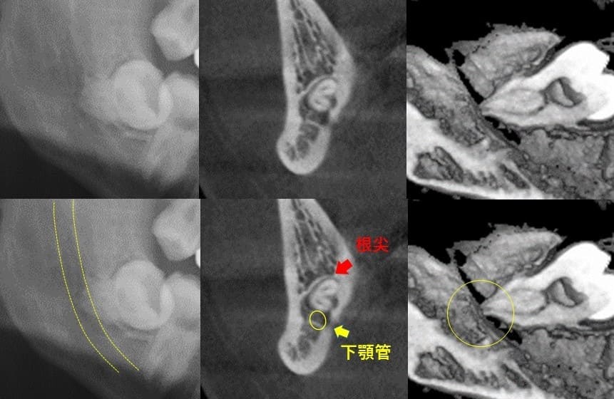 深さが比較的浅いもの（近心傾斜）症例4