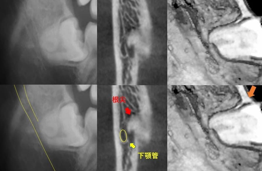 深さが比較的深いもの（近心傾斜）症例1