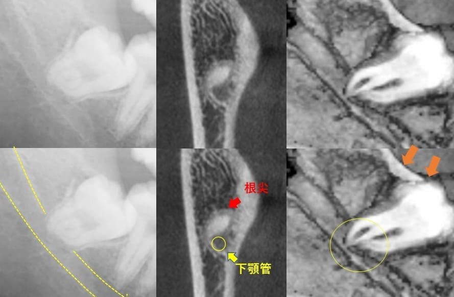 深さが比較的深いもの（近心傾斜）症例5