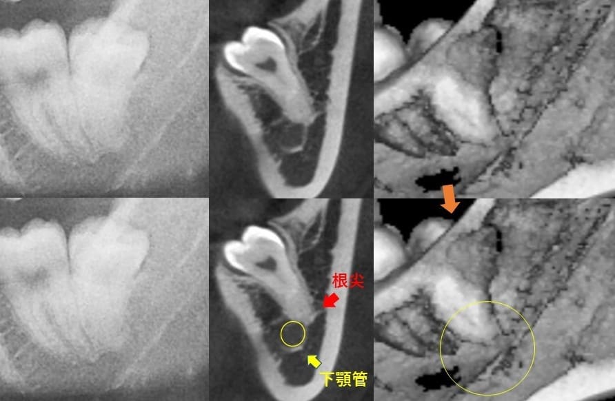 遠心傾斜（後ろの方へに斜めに生える）症例1