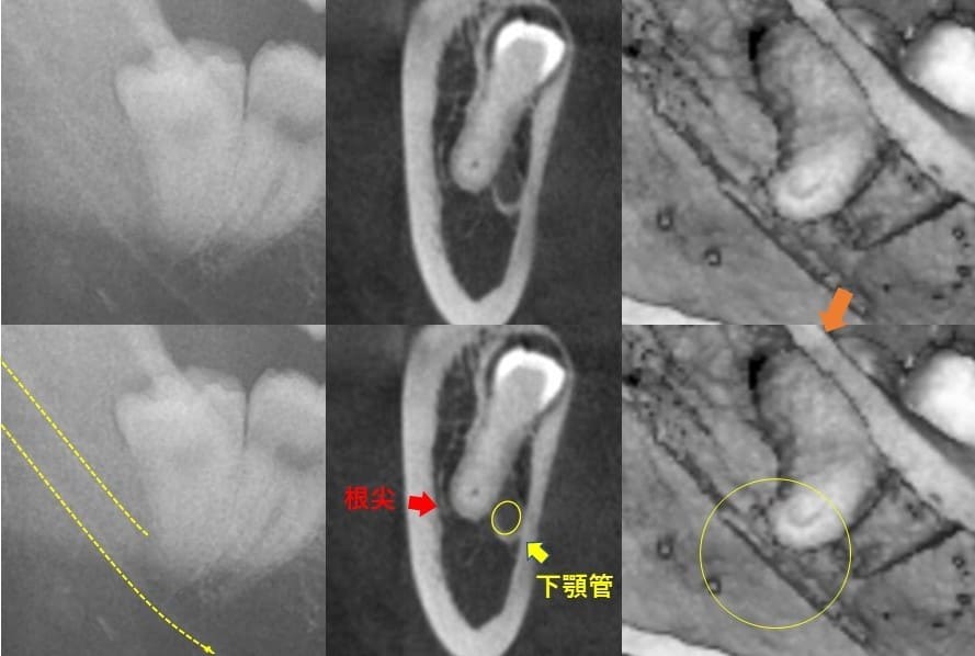 遠心傾斜（後ろの方へに斜めに生える）症例2