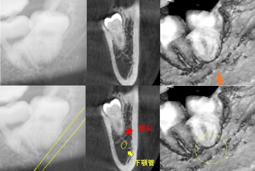 遠心傾斜（後ろの方へに斜めに生える）症例3