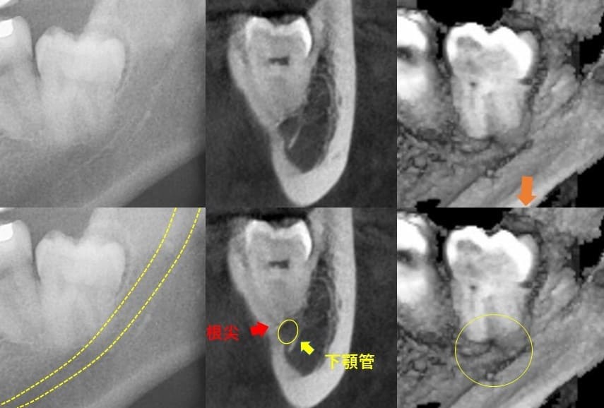 遠心傾斜（後ろの方へに斜めに生える）症例4