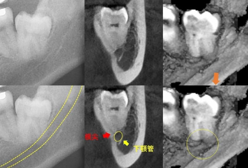 遠心傾斜（後ろの方へに斜めに生える）症例5