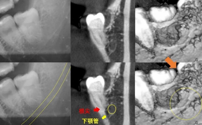 深さが浅いのもの（垂直方向）症例2