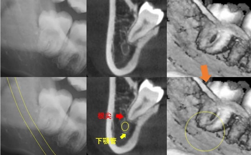 深さが浅いのもの（垂直方向）症例4