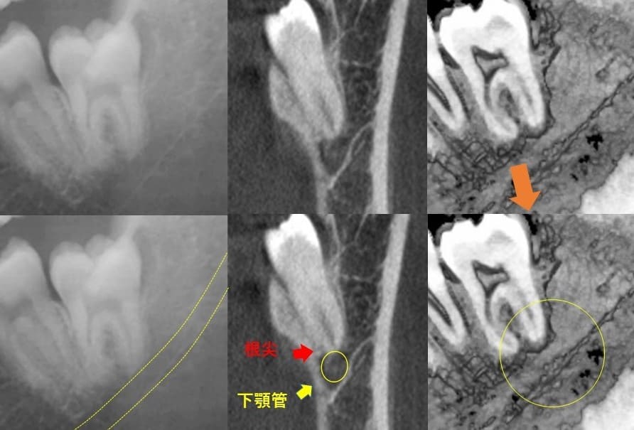 深さが中等度のもの（垂直方向）症例1