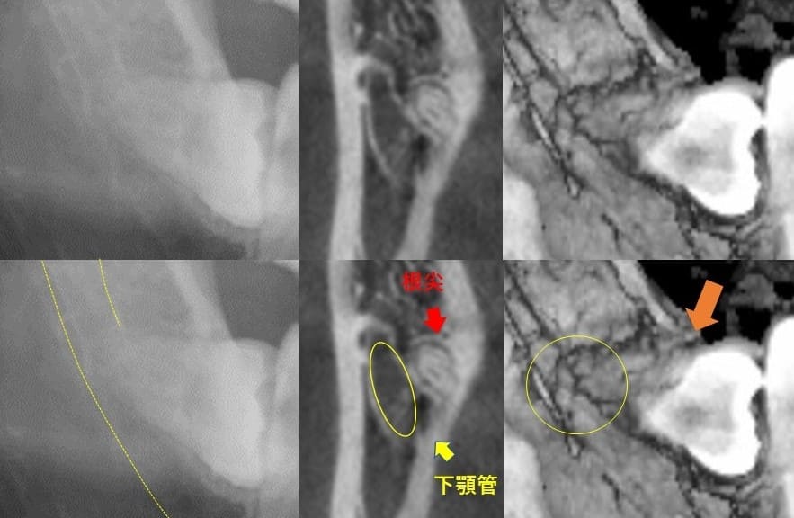 深さが中等度のもの（水平）症例3