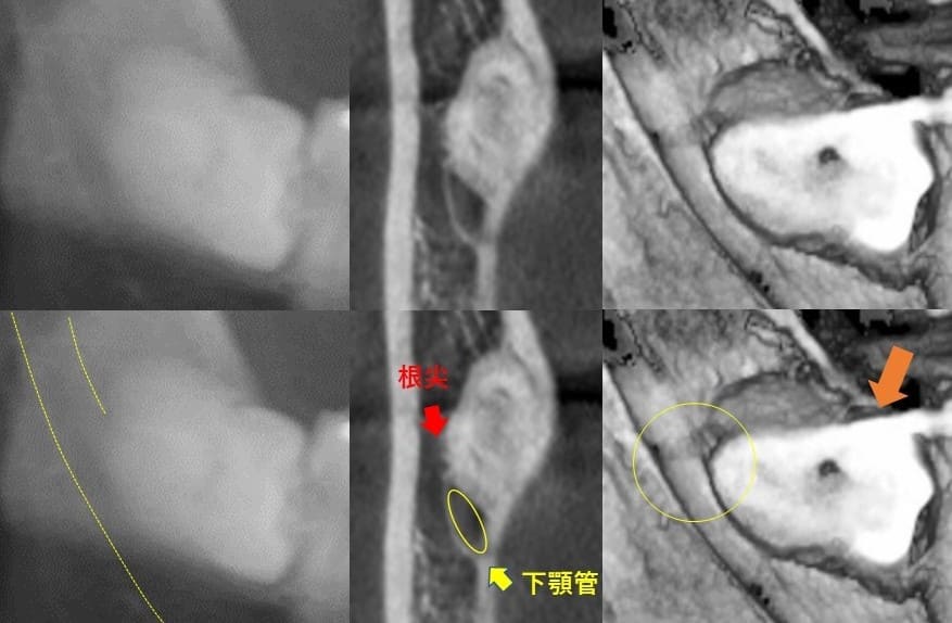 深さが中等度のもの（水平）症例6