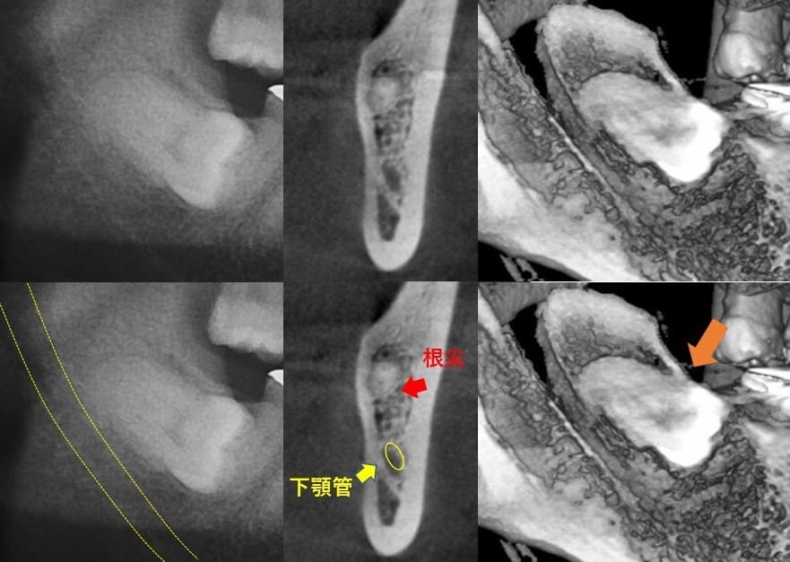 舌の方に斜めに生える（舌側傾斜）症例1