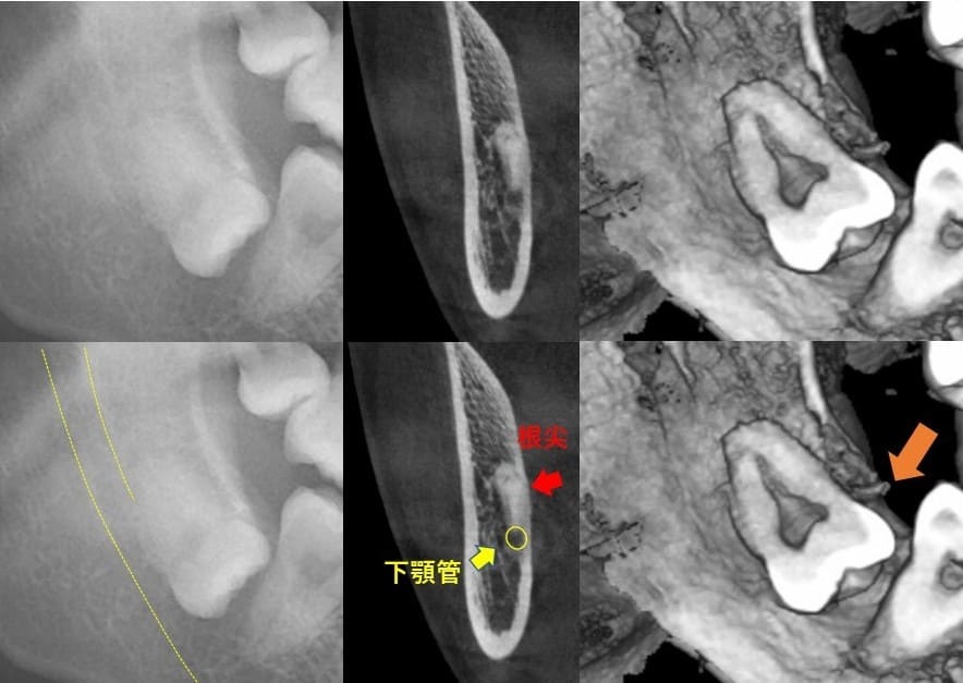 舌の方に斜めに生える（舌側傾斜）症例2