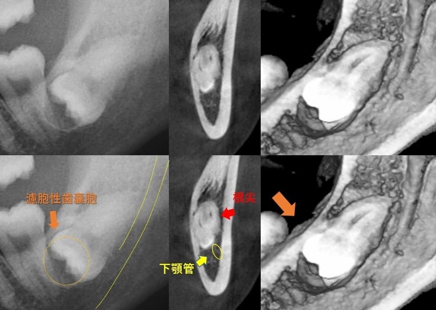 舌の方に斜めに生える（舌側傾斜）症例3