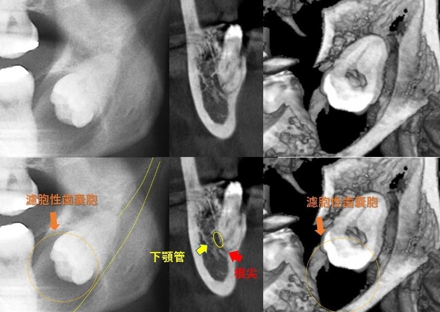 舌の方に斜めに生える（舌側傾斜）症例4