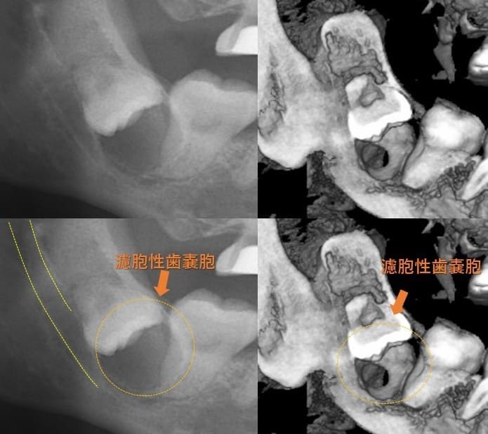 舌の方に斜めに生える（舌側傾斜）症例5