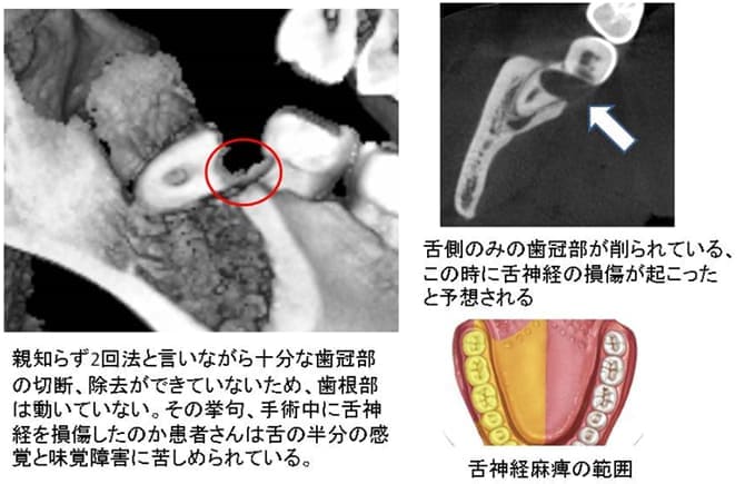 親知らずの2回法の抜歯術