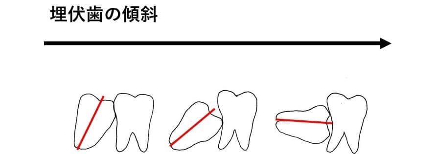 埋伏歯の傾斜