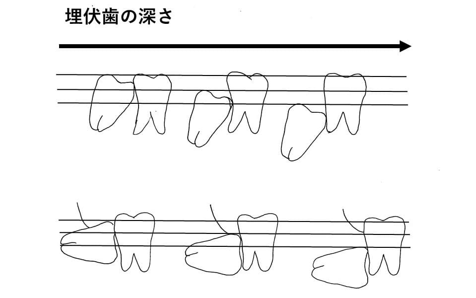 埋伏歯の深さ