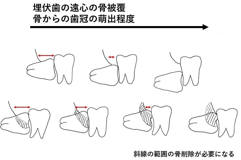 埋伏歯の遠心の骨被覆