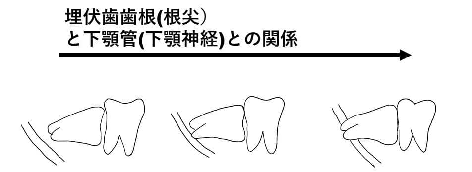 埋伏歯の歯根の尖端と下顎管との関係