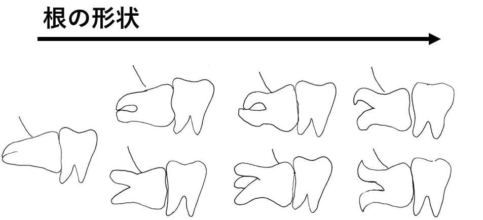 埋伏歯の歯根の形状