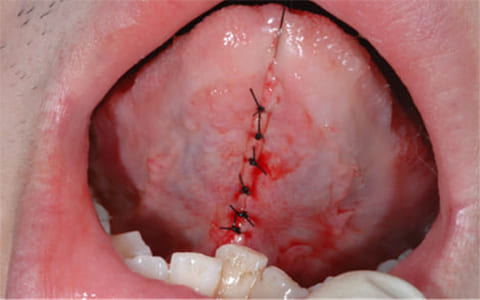舌小帯強直（短縮）症の手術症例ケース４