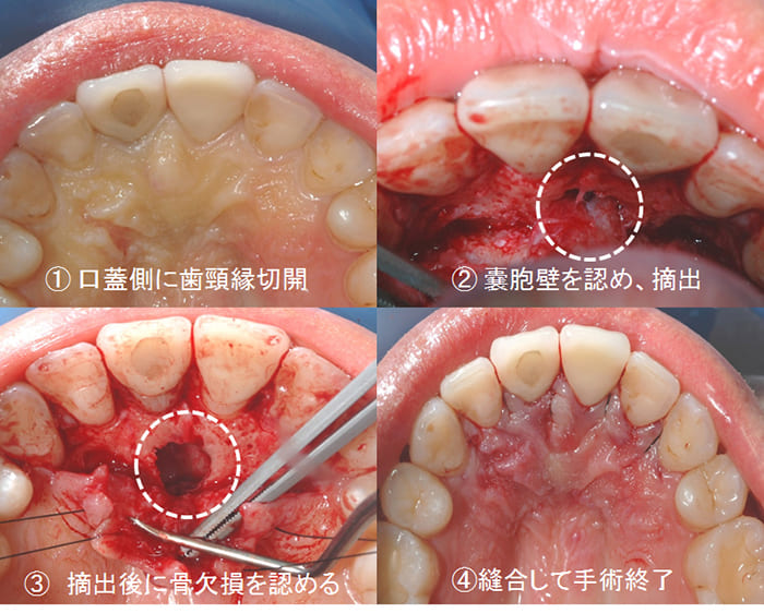 鼻口蓋管嚢胞症例ケース２