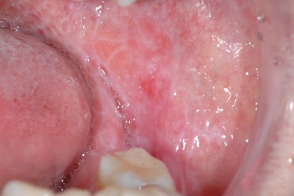 両側頬粘膜ならびに歯肉の口腔扁平苔癬2