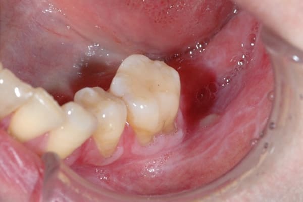 両側頬粘膜ならびに歯肉の口腔扁平苔癬3